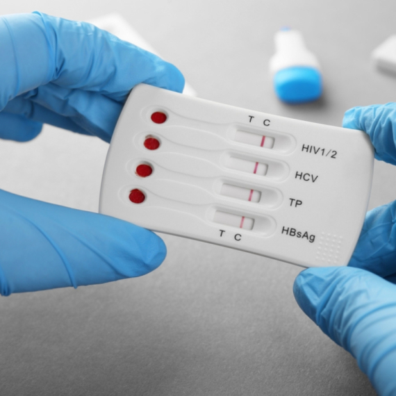 Više od polovine HIV dijagnoza u Evropi postavlja se prekasno