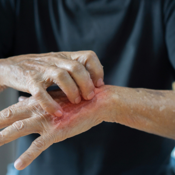 U Dubrovniku zabeležena tri slučaja šuge