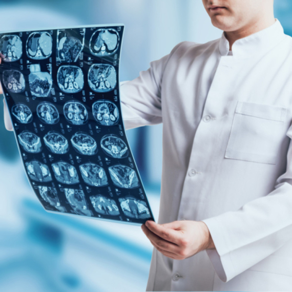 Jednostavan test iz krvi mogao bi spasiti živote obolelih od tumora mozga