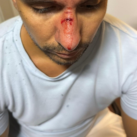 Nasilje blokadera ne prestaje: Pogodili mladića kamenicom u glavu FOTO