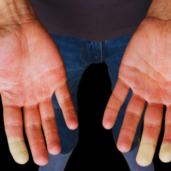 Hladne su vam ruke i stopala: Možda imate Rejnoov sindrom FOTO