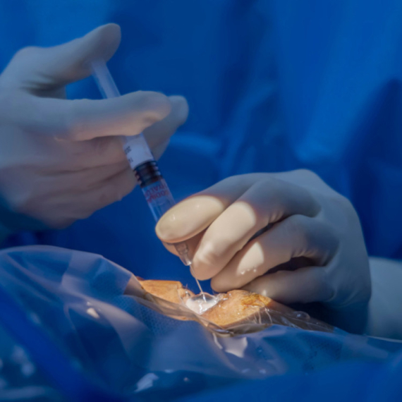 Revolucionarna injekcija gela u oko: Nada za hiljade ljudi FOTO