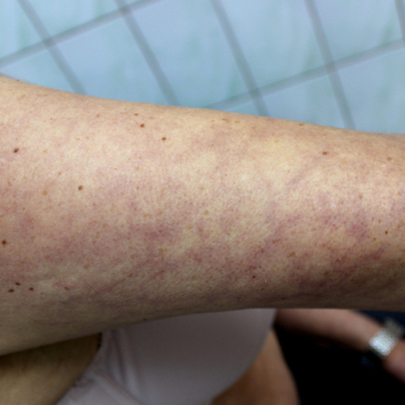 Ove promene na koži mogu ukazivati na opasne kardiovaskularne probleme