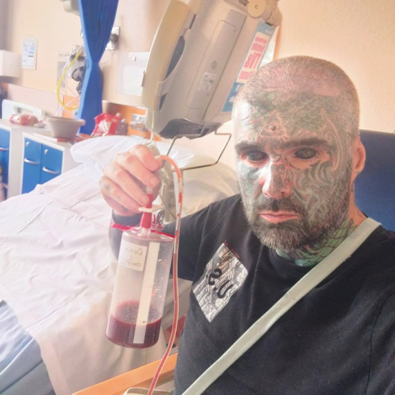 Tetovirao i beonjače, pa iznenada oslepeo: Lekari nemaju odgovor FOTO