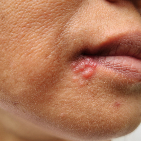 Virus koji milioni imaju: Herpes može da napravi haos u mozgu, čak i najteže bolesti